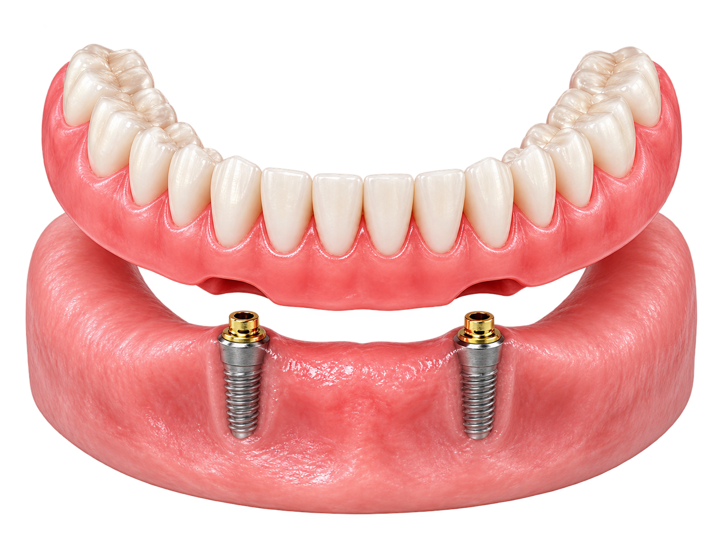 Implant Over / Support Denture